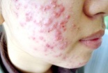 ‘Khóc thét’ vì mặt đầy mụn do dùng kem chống nắng kiểu này
