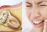 Nhổ răng khôn: Cảnh giác với những biến chứng có thể gây tử vong