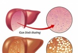 Báo động: Cứ 4 người có 1 người mắc bệnh này, ai đang cần cảnh giác nhất