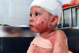 Nghẹn lòng bé gái 5 tuổi bị bỏng nặng trong lúc gia đình đi tắm biển