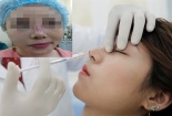 Hoại tử phần thịt ở mũi vì cấy chỉ nâng mũi không đảm bảo