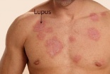 Mắc bệnh Lupus ban đỏ mà sử dụng thuốc liều lĩnh nguy cơ tử vong