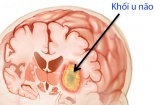 Nhức đầu là một trong 8 dấu hiệu cảnh báo ung thư não