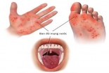 Bệnh tay chân miệng diễn biến rất nhanh có thể gây biến chứng tử vong
