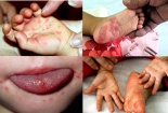 Bệnh tay chân miệng dễ nhầm nhiều bệnh khác, mẹ đừng tự ý mua thuốc kẻo hại con