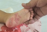 Khuyến cáo: Bệnh tay chân miệng đang 'tấn công' trẻ em không ngừng