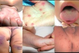 Chăm sóc trẻ tay chân miệng bị sốt cao không hạ