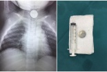 Cảnh báo cha mẹ: Bé 1 tuổi nuốt pin vào thực quản khi bò chơi nền nhà