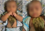 Dùng lá trầu không đắp lên ngực con để thông đờm, chuyên gia cảnh báo chỉ là lời đồn