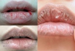 Da khô nẻ do trời lạnh: Cách trị đơn giản không hề tốn tiền