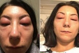 Đi nối mi, một phụ nữ bị dị ứng nghiêm trọng 