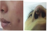 Ham làm đẹp giá rẻ, áp xe má, mũi bất ngờ lồi 'cục lạ'