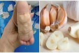 Con lãnh hậu quả nghiêm trọng khi mẹ nghe lời đồn đại đắp tỏi chữa bệnh cho con