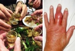 Gia tăng nguy cơ mắc bệnh gút do ăn uống, nhậu nhẹt dịp Tết
