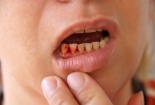 90% người Việt bị sâu răng, viêm lợi