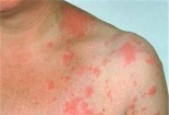 Tìm thấy vi khuẩn có thể đánh bại căn bệnh ung thư