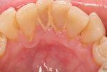 Bày cách siêu đơn giản ‘xua đuổi’ nỗi sợ hãi mang tên ‘cao răng’