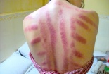 Những người này tuyệt đối không được cạo gió đánh cảm để tránh mất mạng oan 