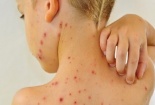 Bệnh thủy đậu càng trầm trọng nếu mắc phải những sai lầm này khi điều trị