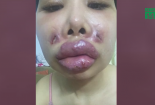 Cô gái biến dạng gương mặt vì tiêm chất làm đầy