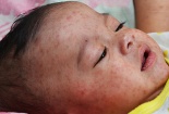 Lầm tưởng 'chết người' về mối liên hệ giữa bệnh rubella, sởi và quai bị