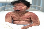 Xót xa bé gái 7 tuổi làn da như 'bỏng nặng' vì uống thuốc không rõ nguồn gốc