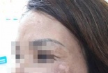 Dùng cao trầu không trị nám, một phụ nữ bị tổn thương da mặt nghiêm trọng