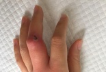 Vết xước nhỏ cũng có thể giết chết bạn, giống như người phụ nữ này!