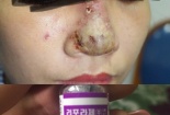 Cô gái hoại tử mũi do tiêm filler sai cách