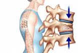 3 dấu hiệu nhận biết loãng xương không nên bỏ qua