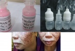 Trị nám, tàn nhang bằng axit: Xu hướng làm đẹp nguy hiểm