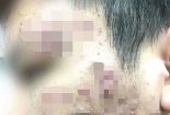 Mua kem trị trứng cá qua mạng, mặt chàng trai nổi chi chít mụn mủ