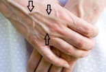 Nổi gân xanh - có thể là dấu hiệu bệnh nguy hiểm