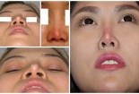 Những nguy hại từ việc nâng mũi bằng sụn tự thân
