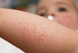 Cẩn trọng dị ứng da vào mùa đông