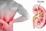 Bệnh sỏi thận - Điều trị sai có thể gây vỡ thận, tử vong cao