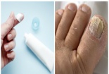 Dùng thuốc chống nấm ketoconazol cần hết sức thận trọng