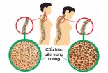 3 dấu hiệu cảnh báo cơ thể bạn đang thiếu canxi trầm trọng