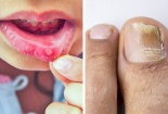 8 tác dụng phụ của thuốc kháng sinh bác sĩ hiếm khi cho biết 
