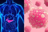 Ung thư tuyến tụy: Kẻ sát nhân thầm lặng