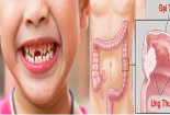 Bệnh nhân ung thư đại tràng sẽ gần 'tử thần' hơn nếu không đề phòng loại vi khuẩn này
