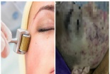 Mặt cô gái mọc mụn mủ dày đặc sau lăn kim, nhiều biến chứng còn đáng sợ hơn