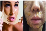 Bỏng nặng toàn khuôn mặt sau khi dùng mỹ phẩm peel da để lột da mặt