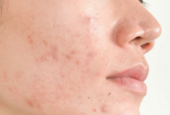 Da bị mụn - Những tác nhân không ngờ cần biết để tránh
