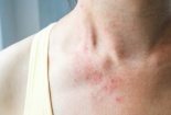 Bị dị ứng với răng giả bằng niken khiến người phụ nữ phát bệnh chàm