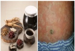 Bị ung thư da do nhiều năm uống thuốc đông y không rõ nguồn gốc
