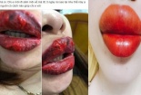 Hậu quả 'ghê rợn' của việc phun xăm môi