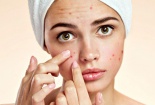 Cân nhắc kỹ khi bổ sung thực phẩm chức năng DIM hỗ trợ trị mụn trứng cá