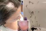 Cô gái phải cạo trọc đầu do dùng dầu xả tóc có thuốc tẩy lông