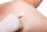Bào chế thành công vắc xin nano 'khắc chế' ung thư da